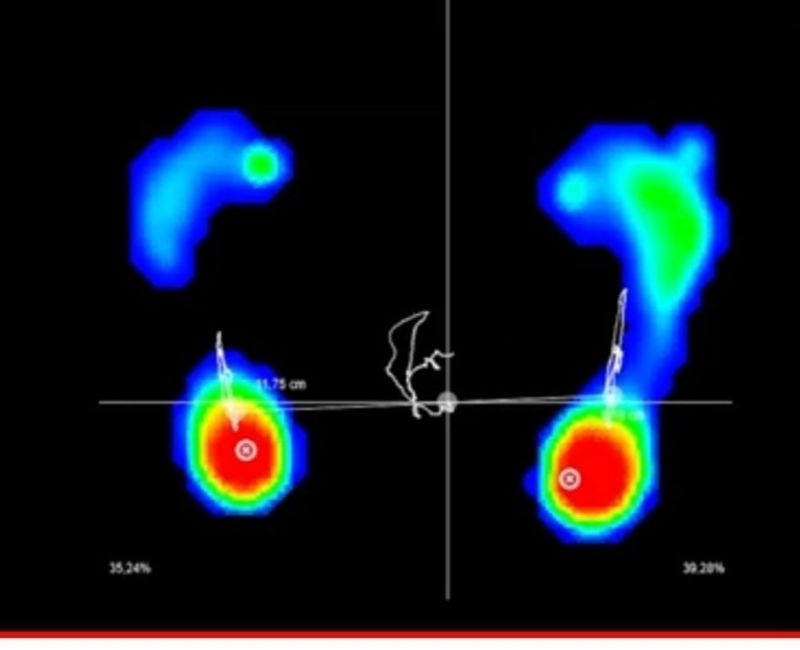 BaroScan - Baropodometria